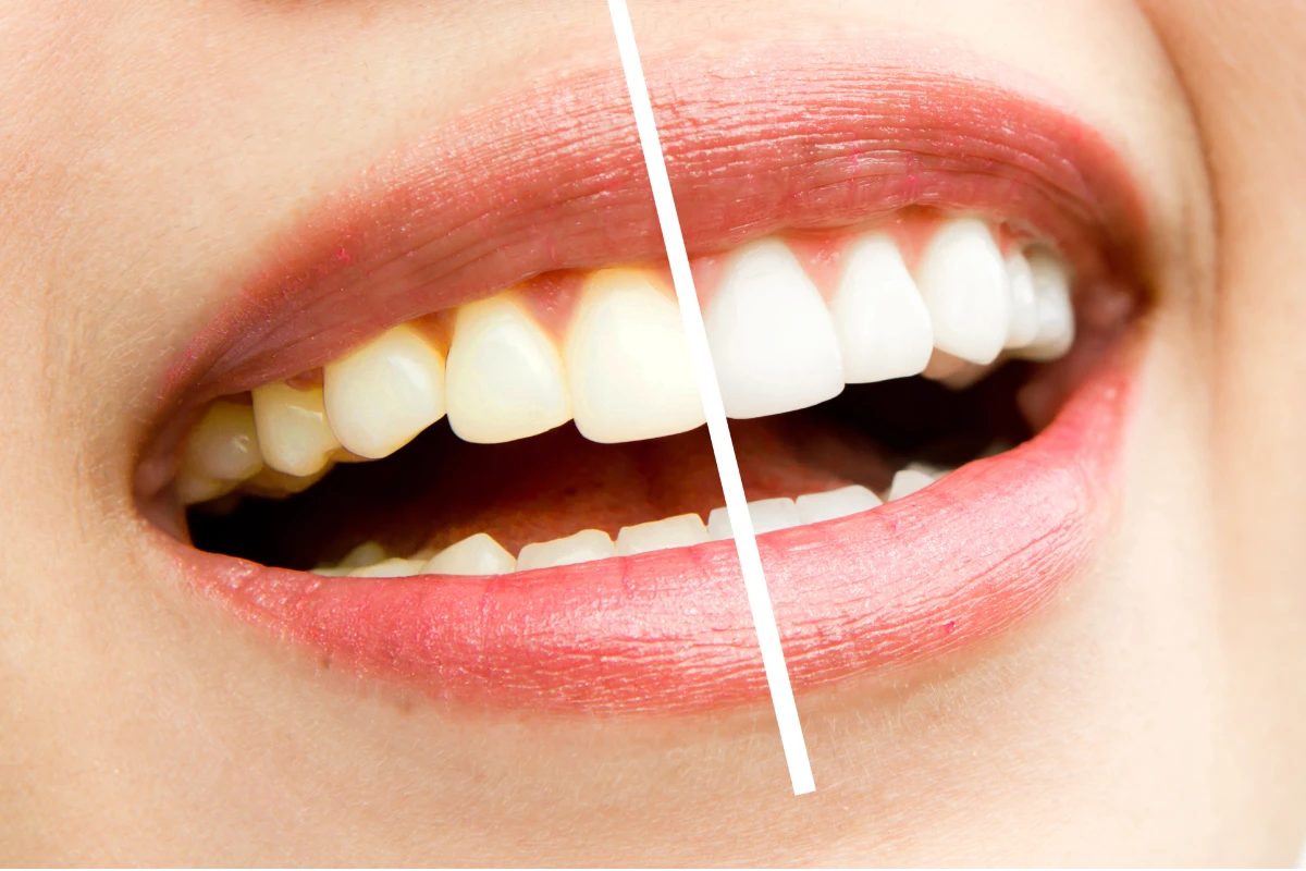 Dis Beyazlatma Teeth Whitening